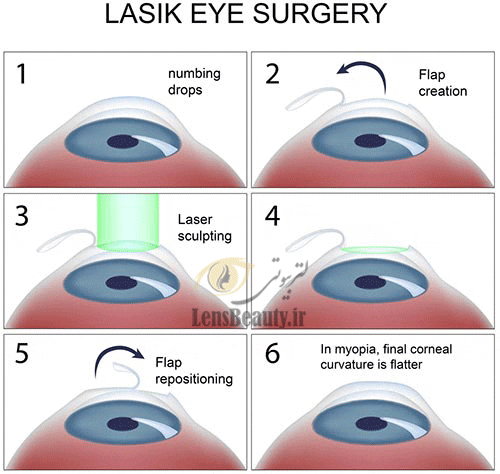 روش انجام عمل لیزیک چشم