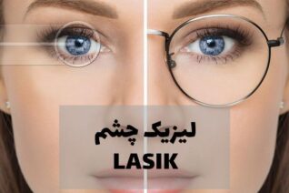 عمل لیزیک چشم