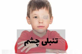 تنبلی چشم