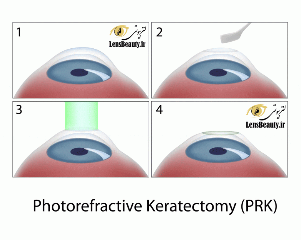 روش انجام لیزر چشم (عمل PRK چشم)
