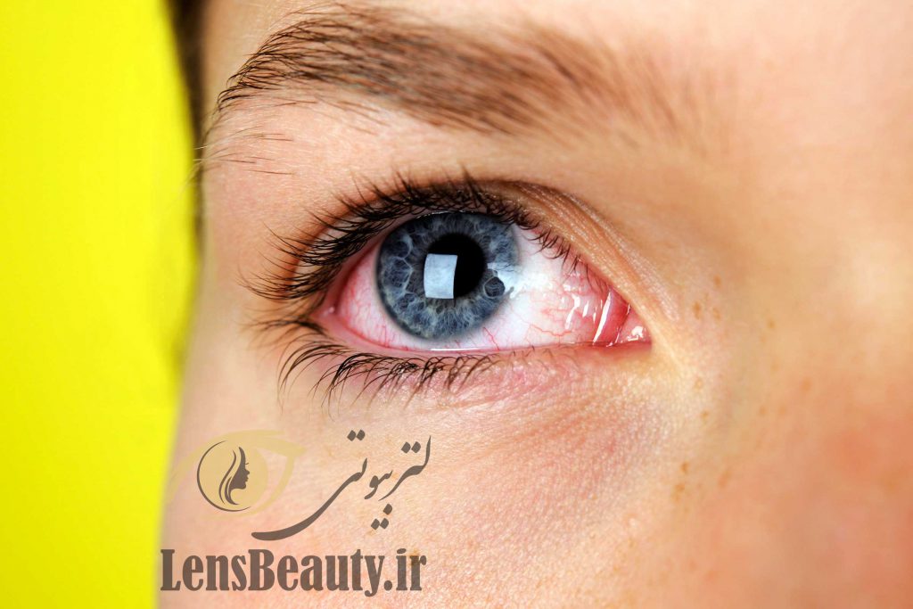 علت خشکی چشم و راه های درمان خشکی چشم