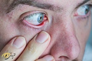 برای درمان خشکی چشم باید از اشک مصنوعی مناسب استفاده کنید.