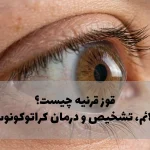 قوز قرنیه چیست؟ علائم، تشخیص و درمان کراتوکونوس به زبان ساده