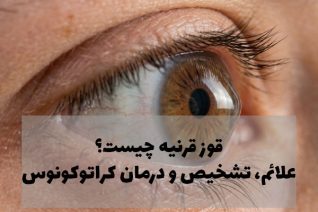 قوز قرنیه چیست؟