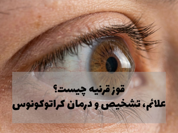 قوز قرنیه چیست؟
